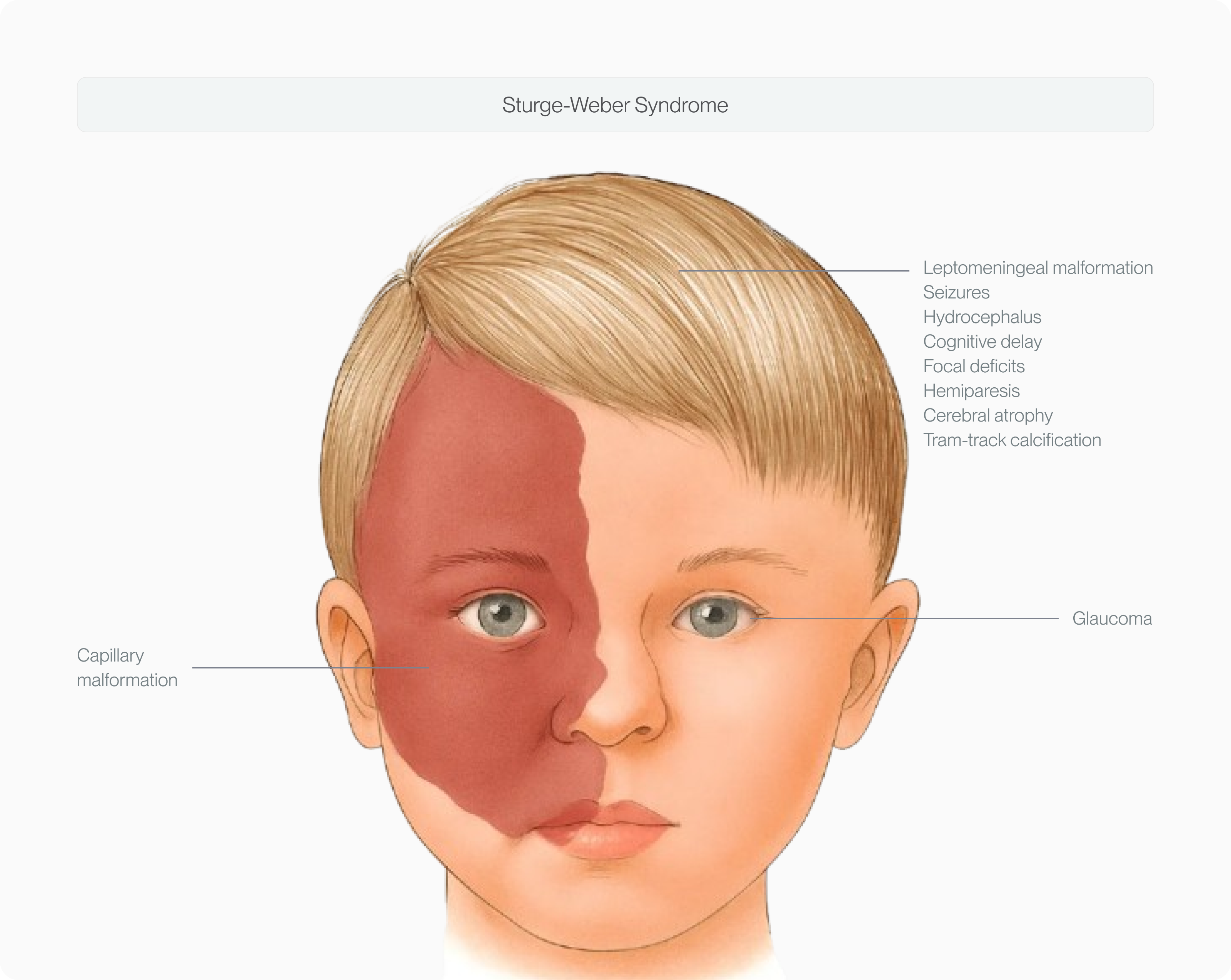 Sturge-Weber Syndrome