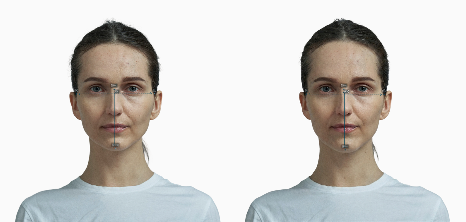 Female frontal portrait with face lengthened, facial index 0.76 to 0.77