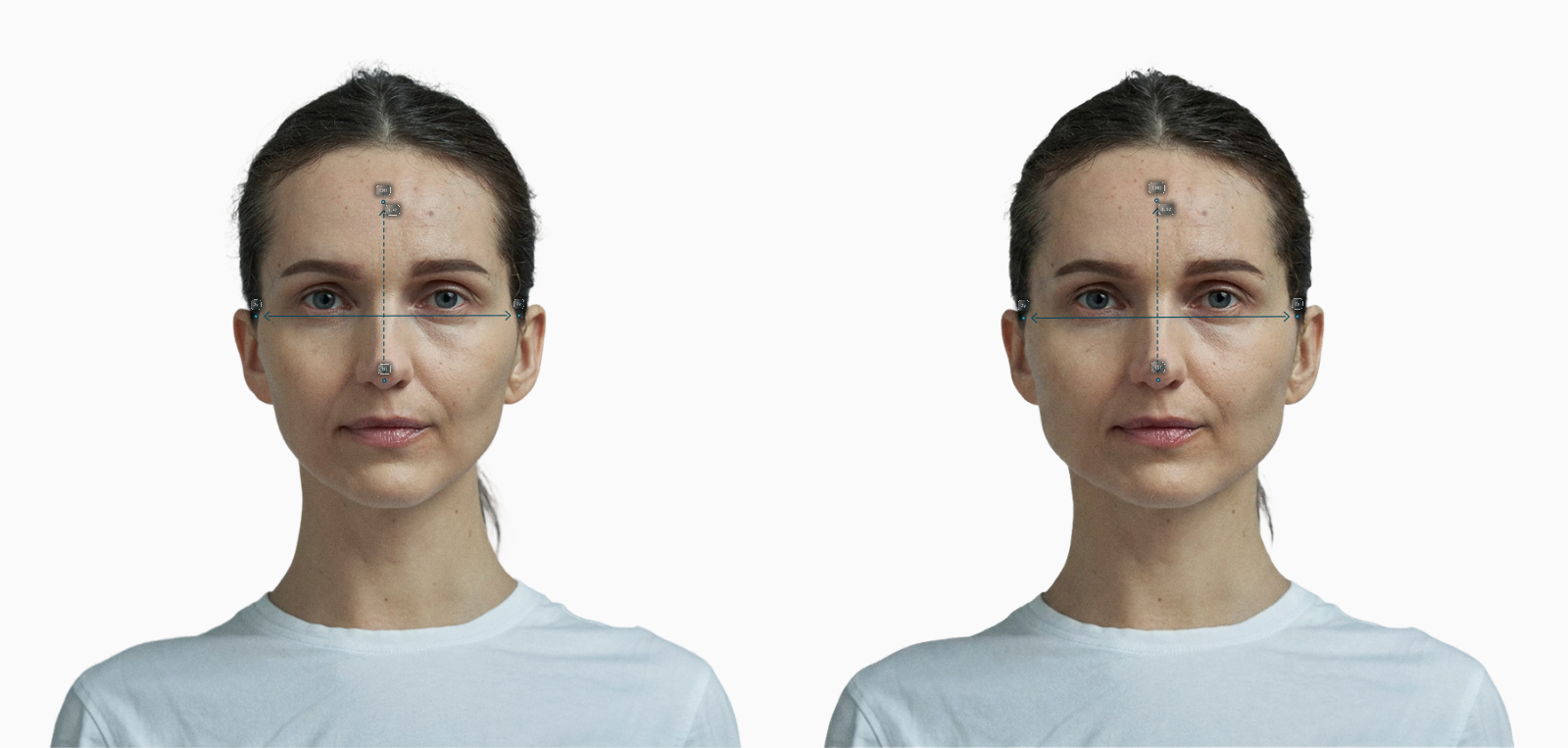 Female frontal portrait with lower face widened, FWHR 1.47 to 1.49