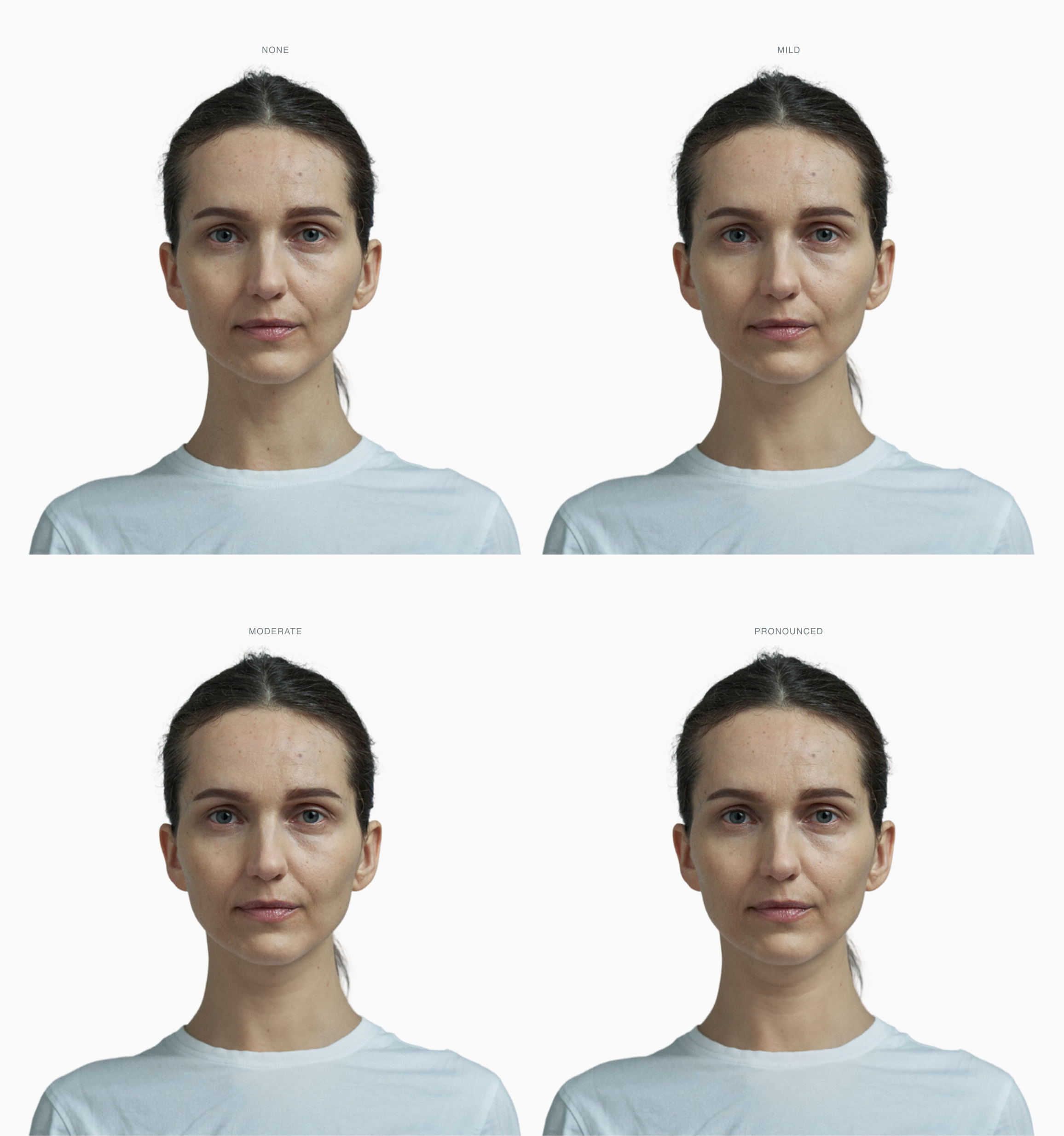 One face at four stages of a double chin, from none to pronounced