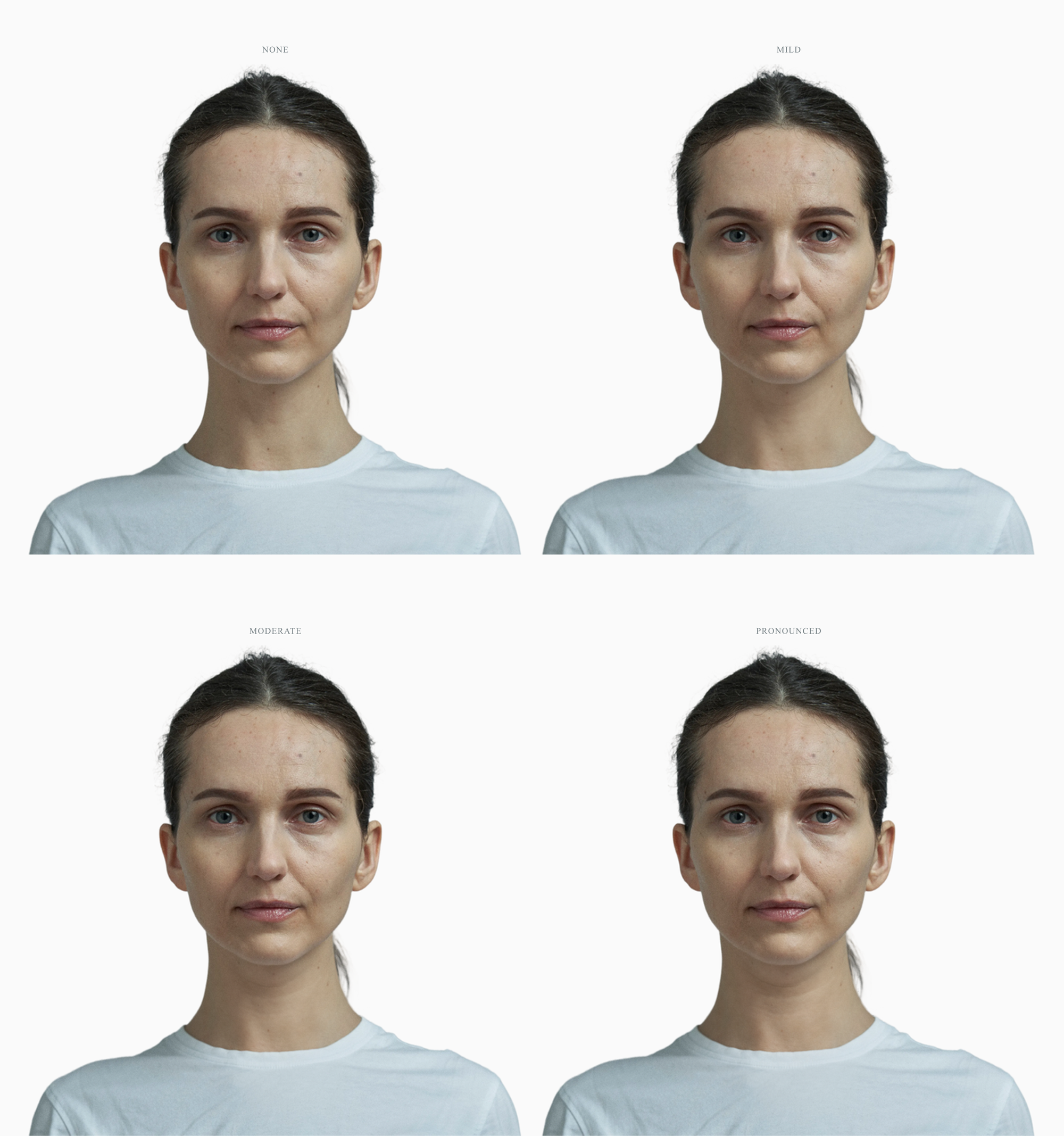 One face at four stages of a double chin, from none to pronounced