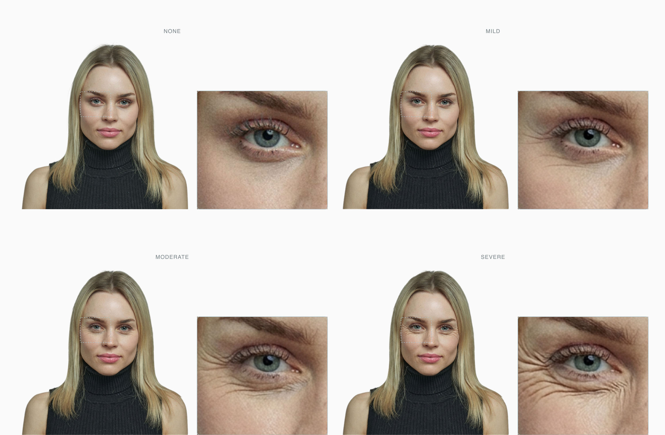Four stages of crow's feet severity on the same female face, each shown as a portrait plus a zoom on the eye Four stages of crow's feet severity on the same female face, each shown as a portrait plus a zoom on the eye