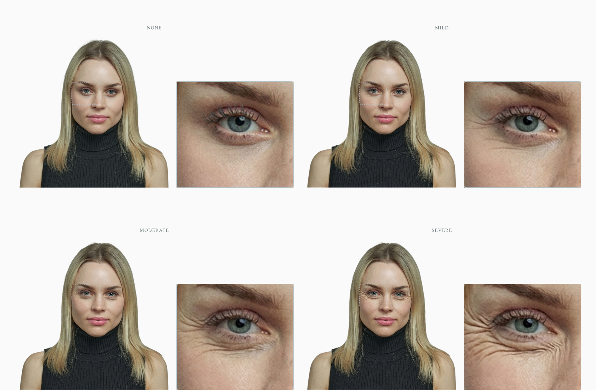 Four stages of crow's feet severity on the same female face, each shown as a portrait plus a zoom on the eye