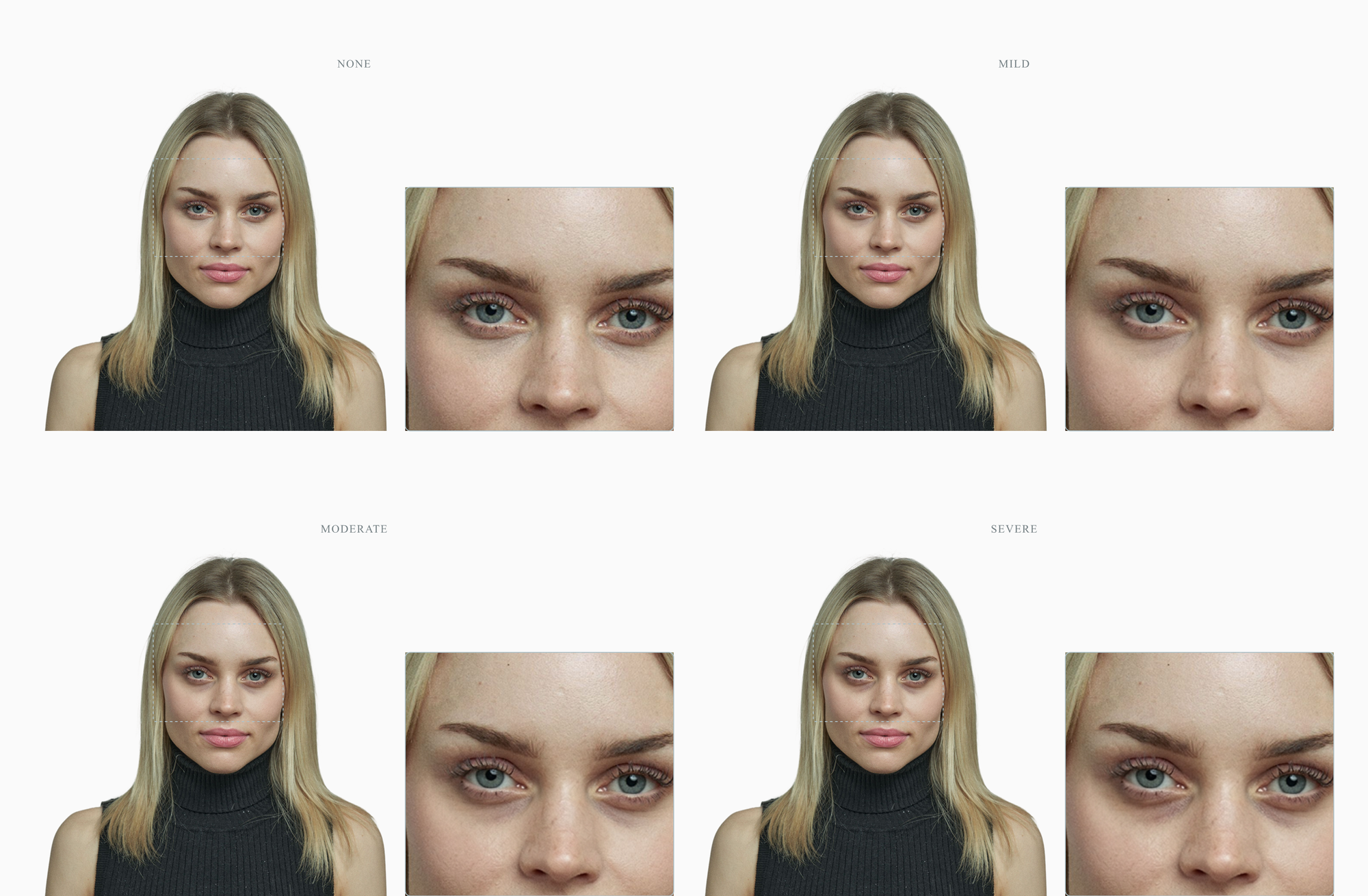 Under-eye dark-circle severity progression on a single face — none, mild, moderate, severe