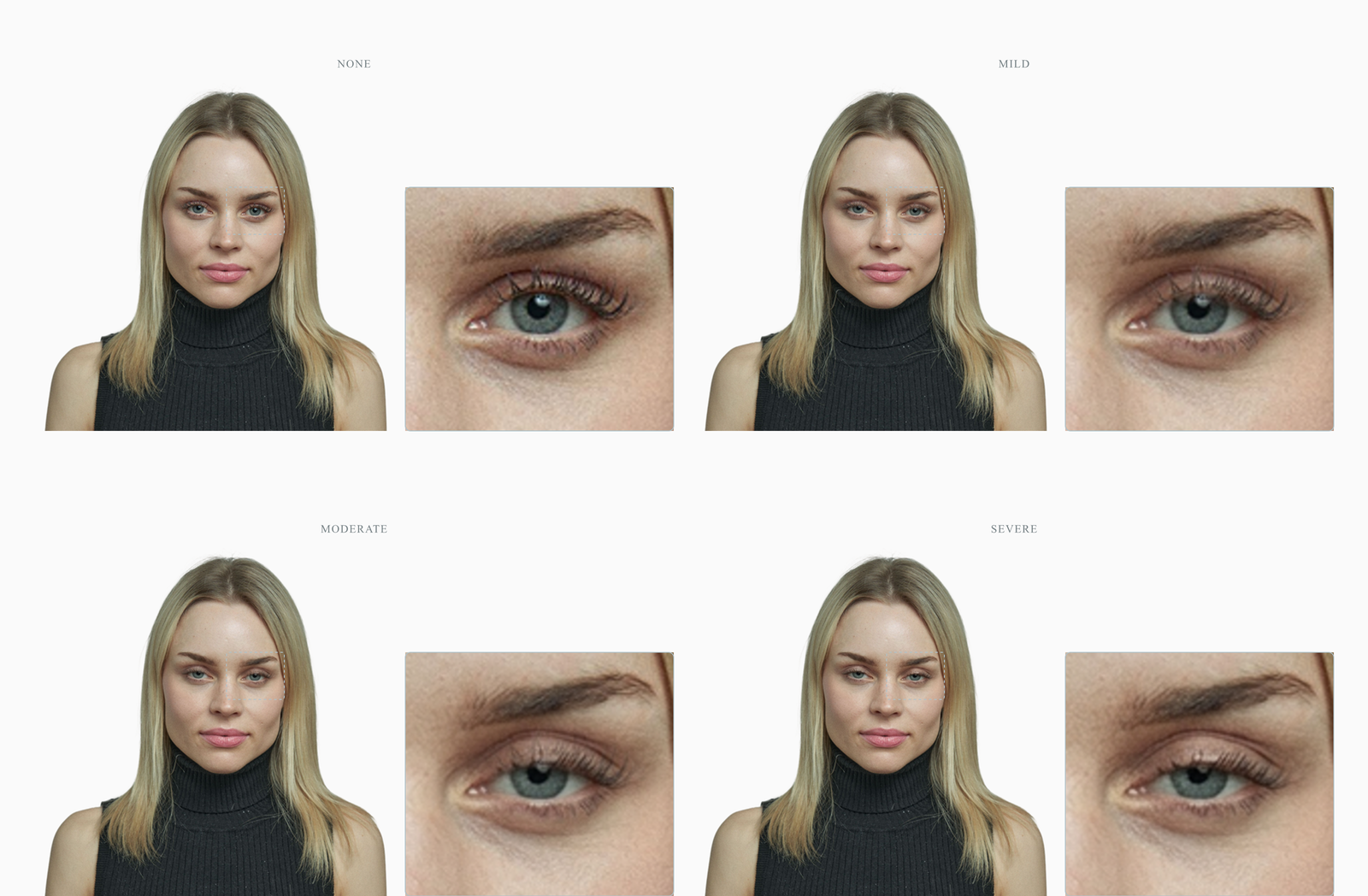 Eyelid ptosis severity from none to severe on a single face, lid margin descending