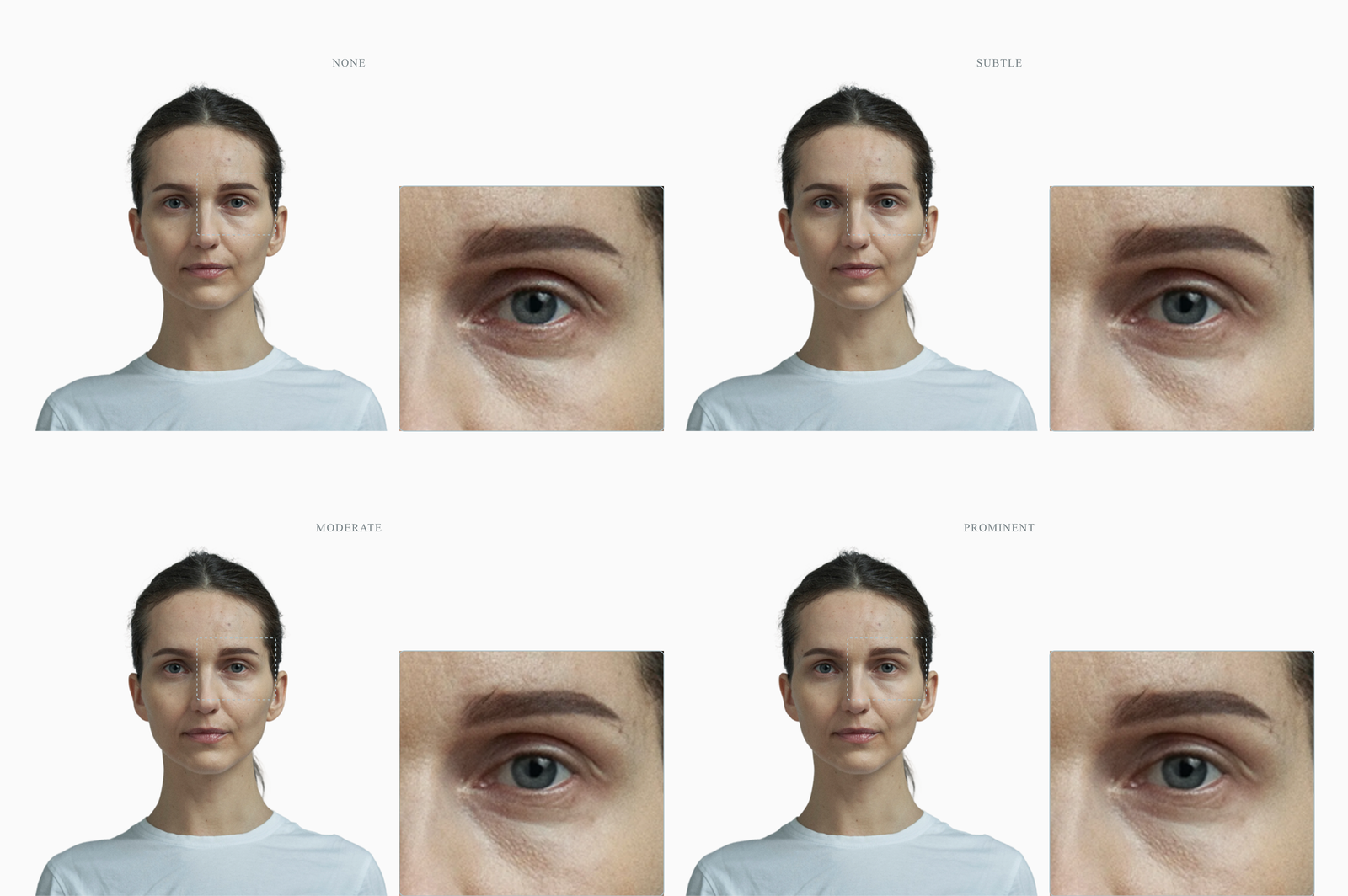 One female face shown at four levels of epicanthic-fold prominence from none to prominent, single inner-corner zoom panel beside each frame