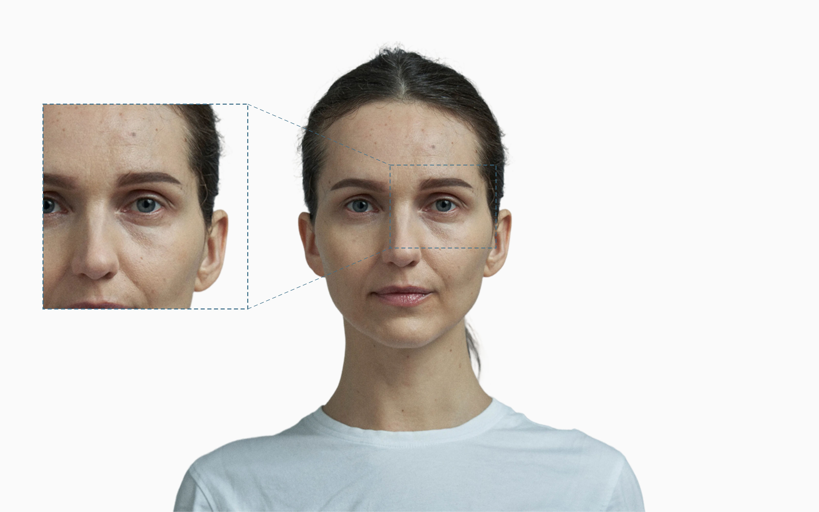 Female frontal portrait with an epicanthic fold at the inner corner of the left eye, magnified in a side callout Female frontal portrait with an epicanthic fold at the inner corner of the left eye, magnified in a side callout