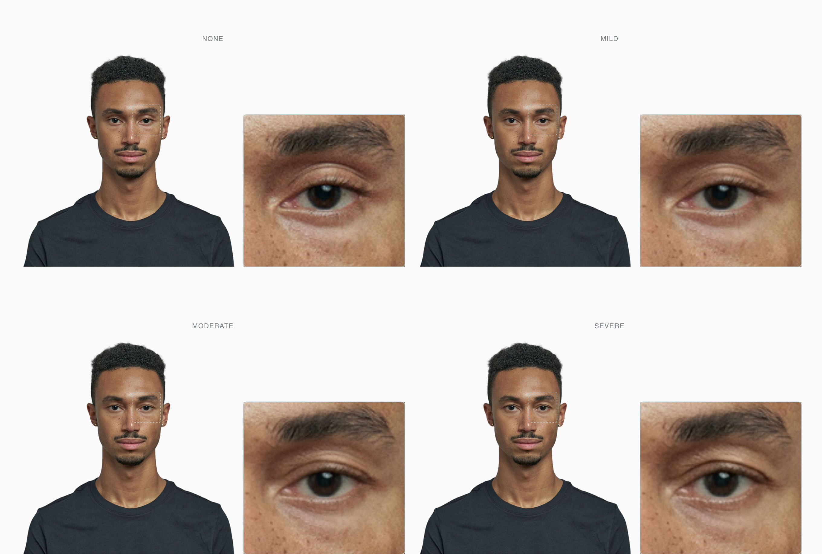 Hooded eyes at four stages, none to severe, with a single-eye zoom in each panel Hooded eyes at four stages, none to severe, with a single-eye zoom in each panel