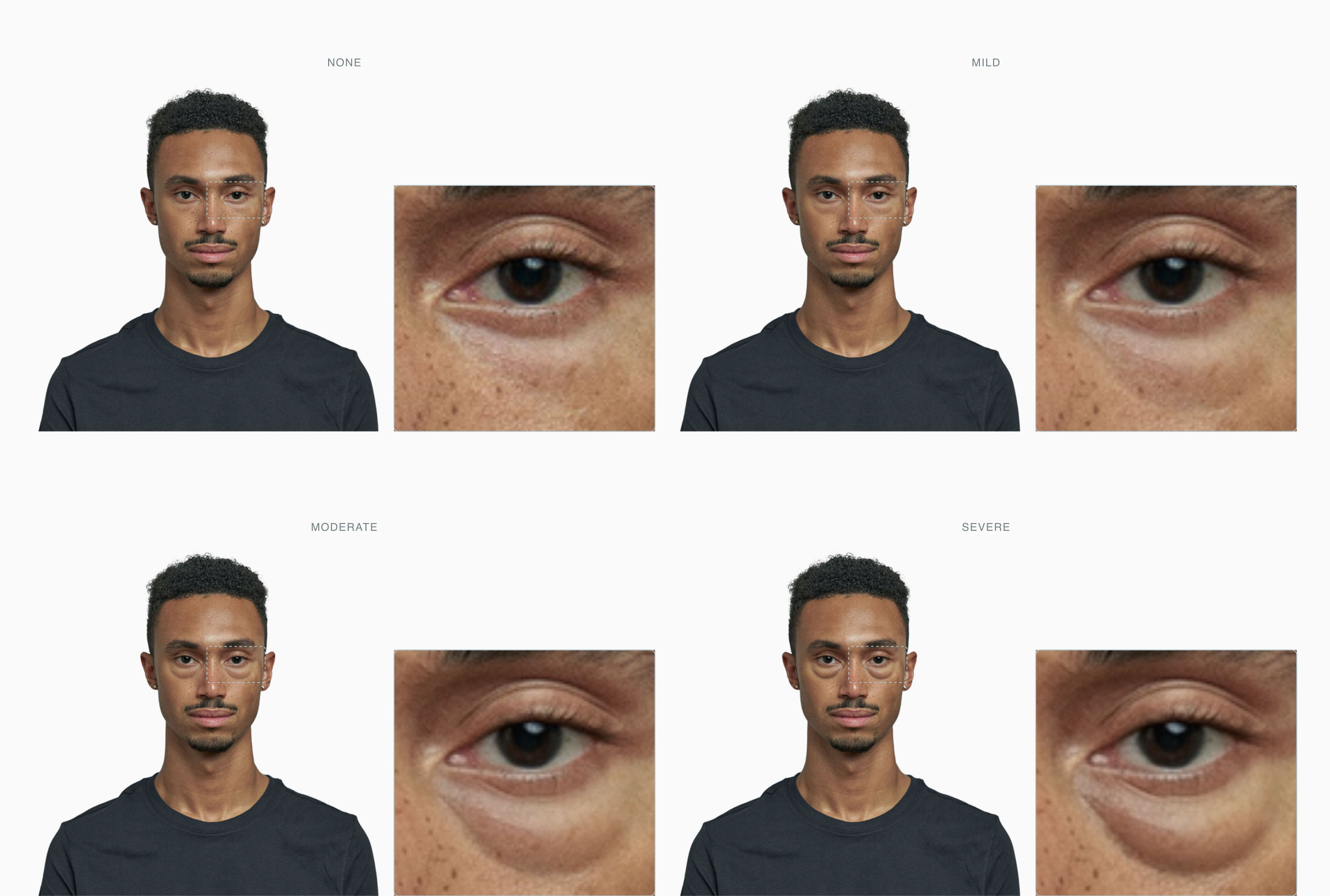 Four-stage severity progression of nasojugal fat pads from none to severe on the same face, with a zoomed under-eye panel beside each portrait Four-stage severity progression of nasojugal fat pads from none to severe on the same face, with a zoomed under-eye panel beside each portrait