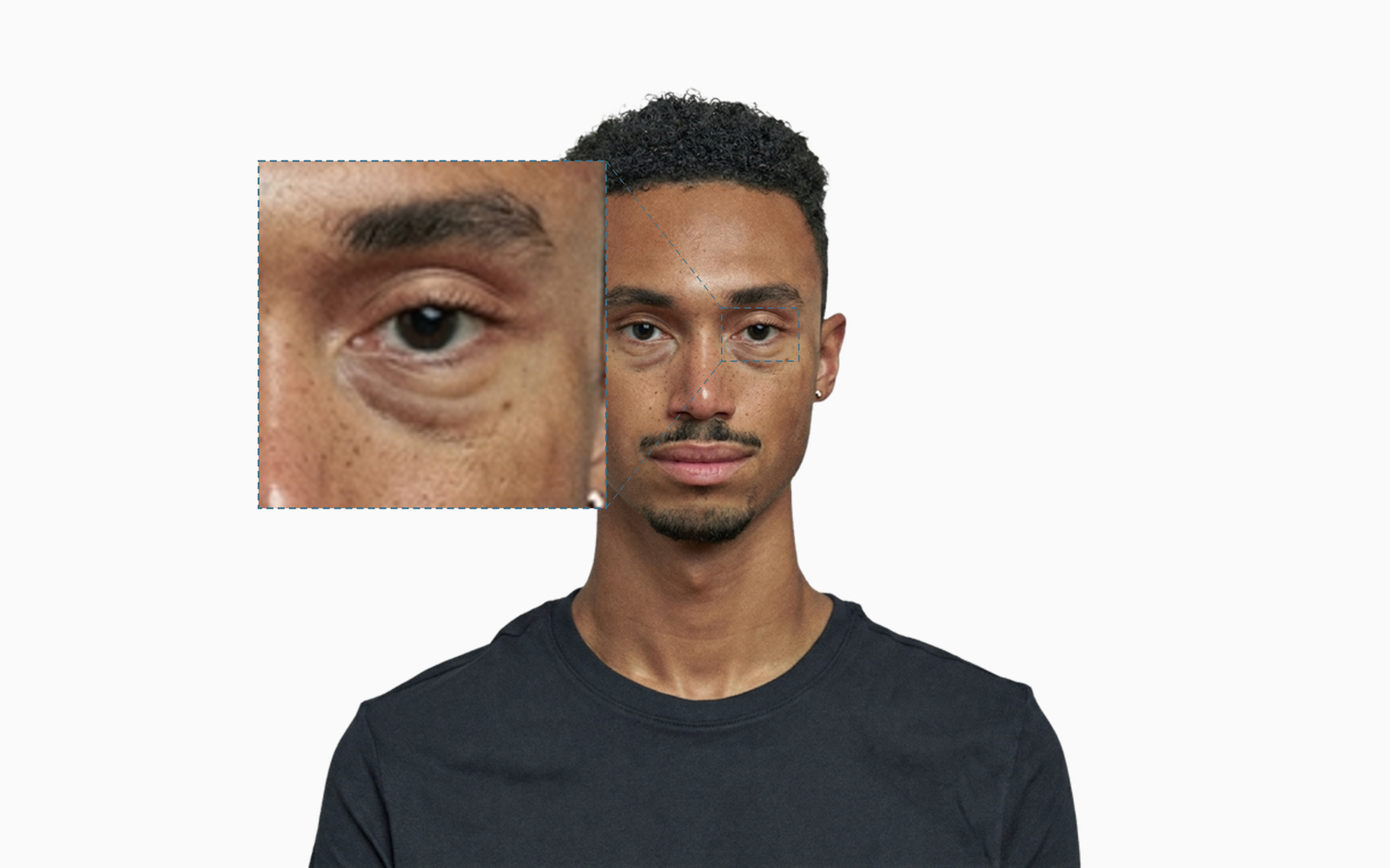 Nasojugal fat pads on a young adult man, with a dashed callout around the under-eye region