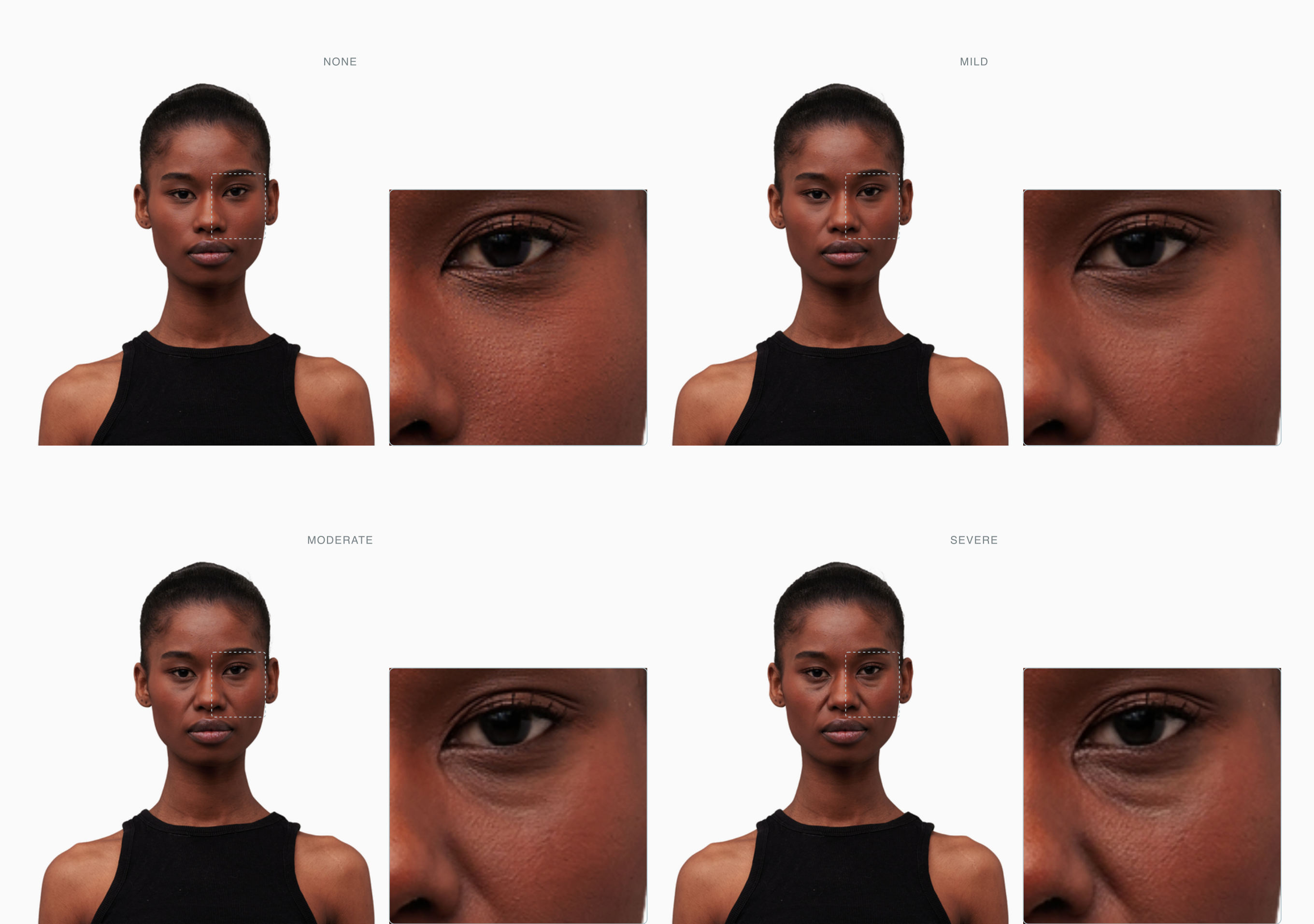 Four-stage progression of nasojugal-line severity on a single face, none through severe