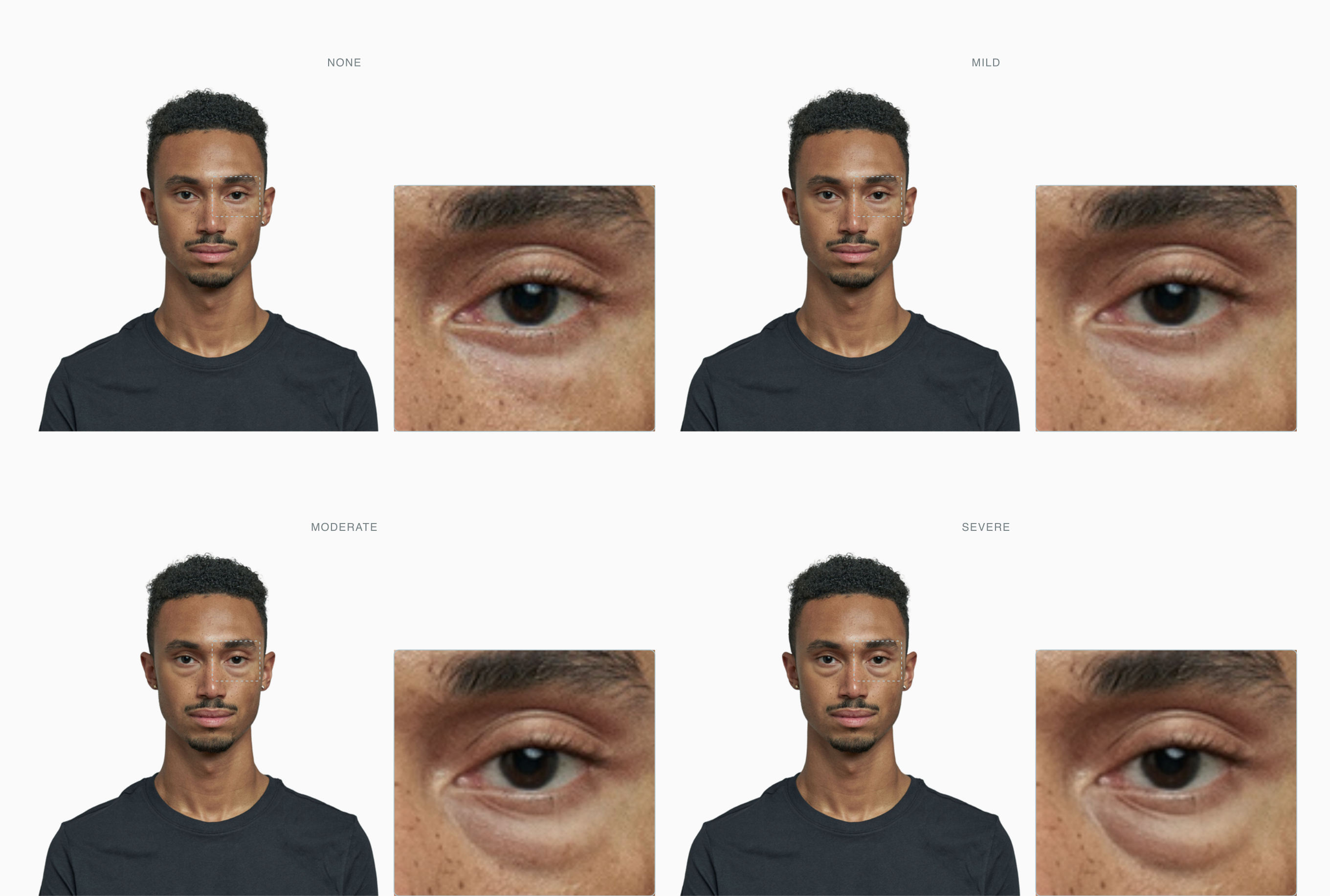 Lower-lid bag severity progression from absent to severe across four stages Lower-lid bag severity progression from absent to severe across four stages