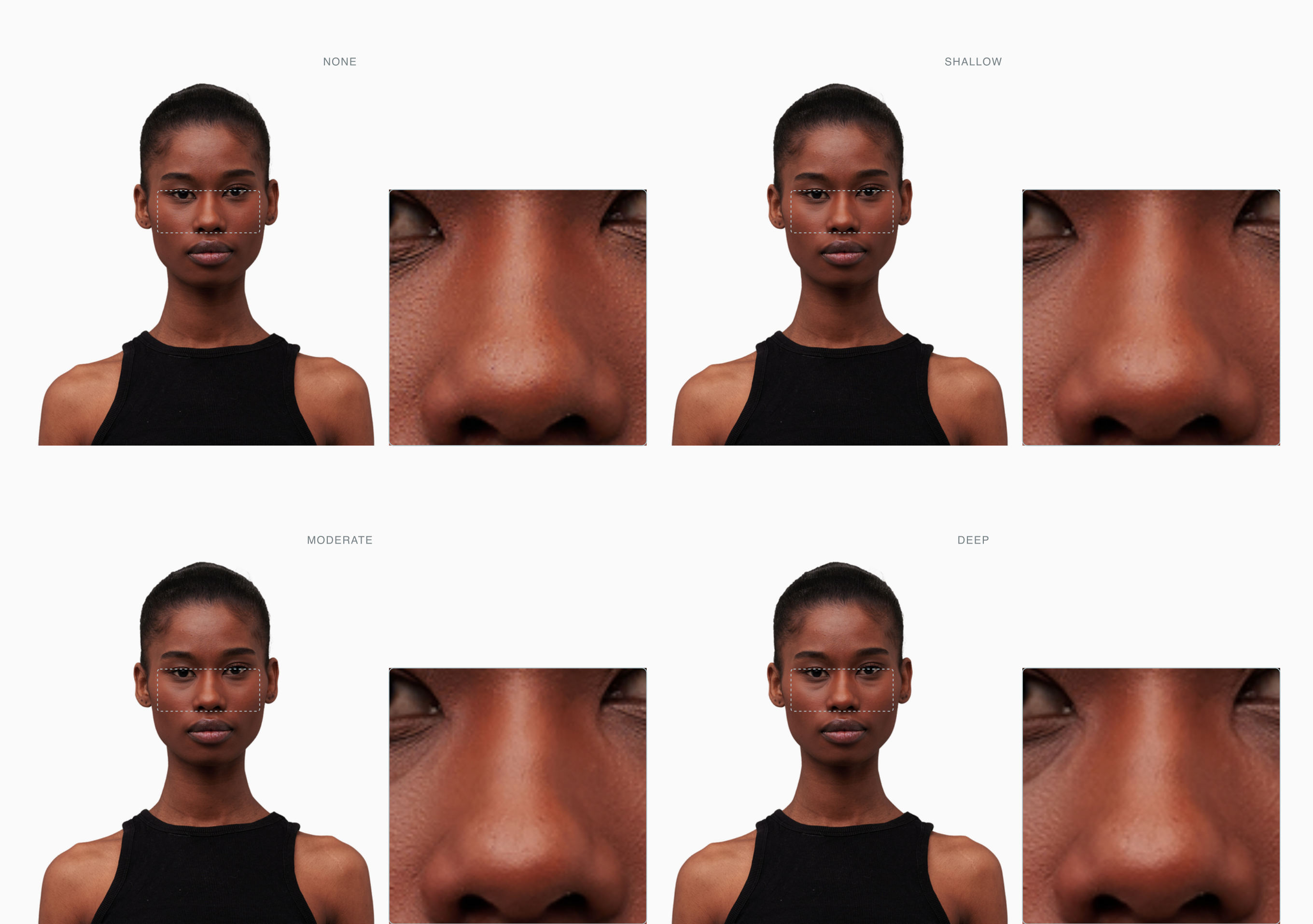 One face at four tear trough depths, none to deep, under-eye area magnified One face at four tear trough depths, none to deep, under-eye area magnified