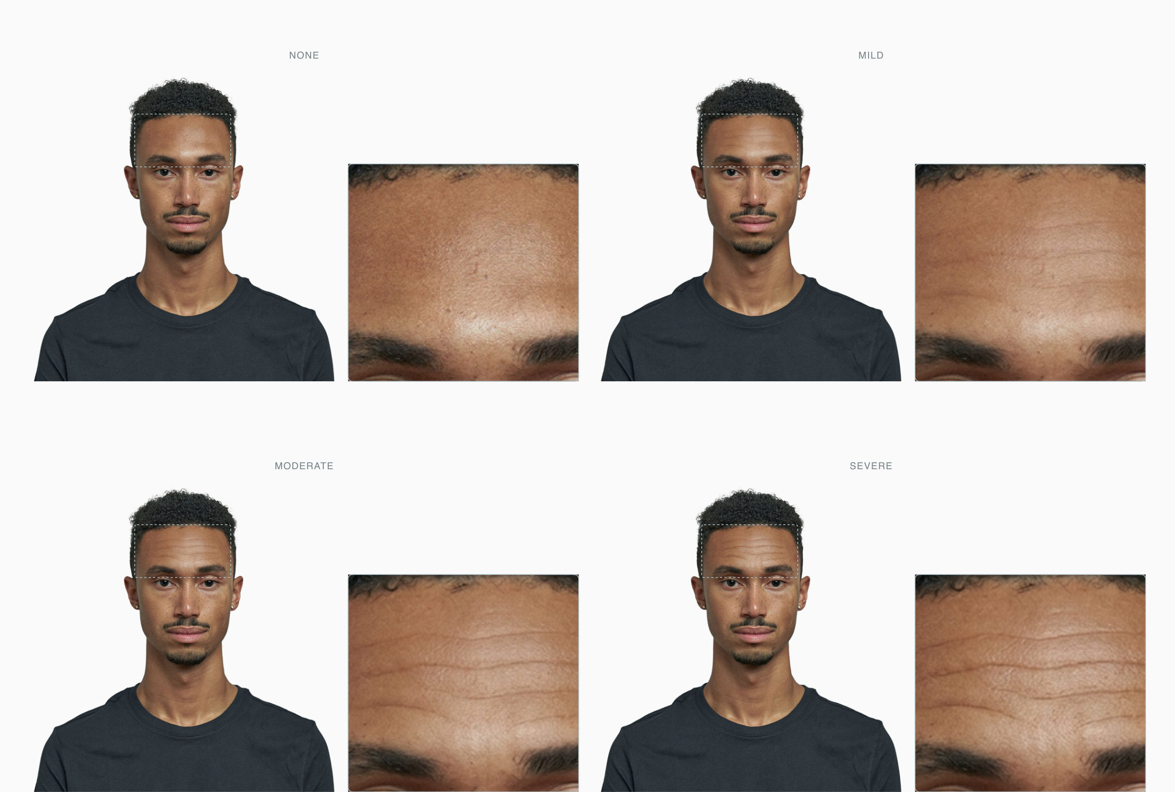 One forehead across four stages, from smooth to deeply creased horizontal lines One forehead across four stages, from smooth to deeply creased horizontal lines