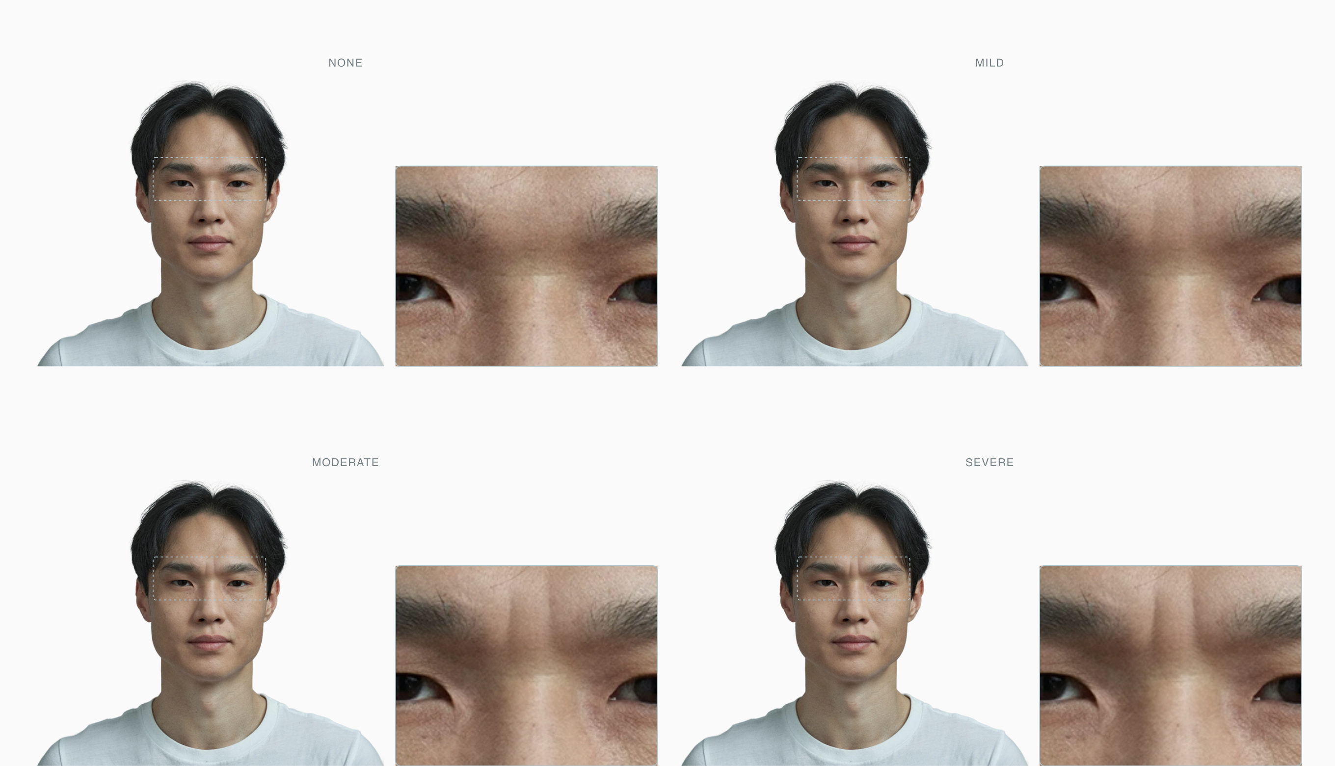 Frown lines deepening across four stages between the eyebrows on the same face Frown lines deepening across four stages between the eyebrows on the same face