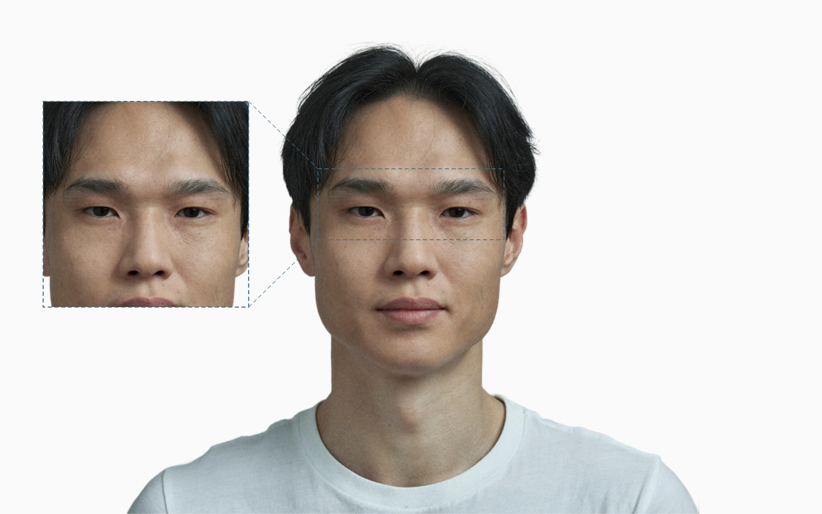 Frown lines between the eyebrows on a portrait with a magnified glabella callout Frown lines between the eyebrows on a portrait with a magnified glabella callout