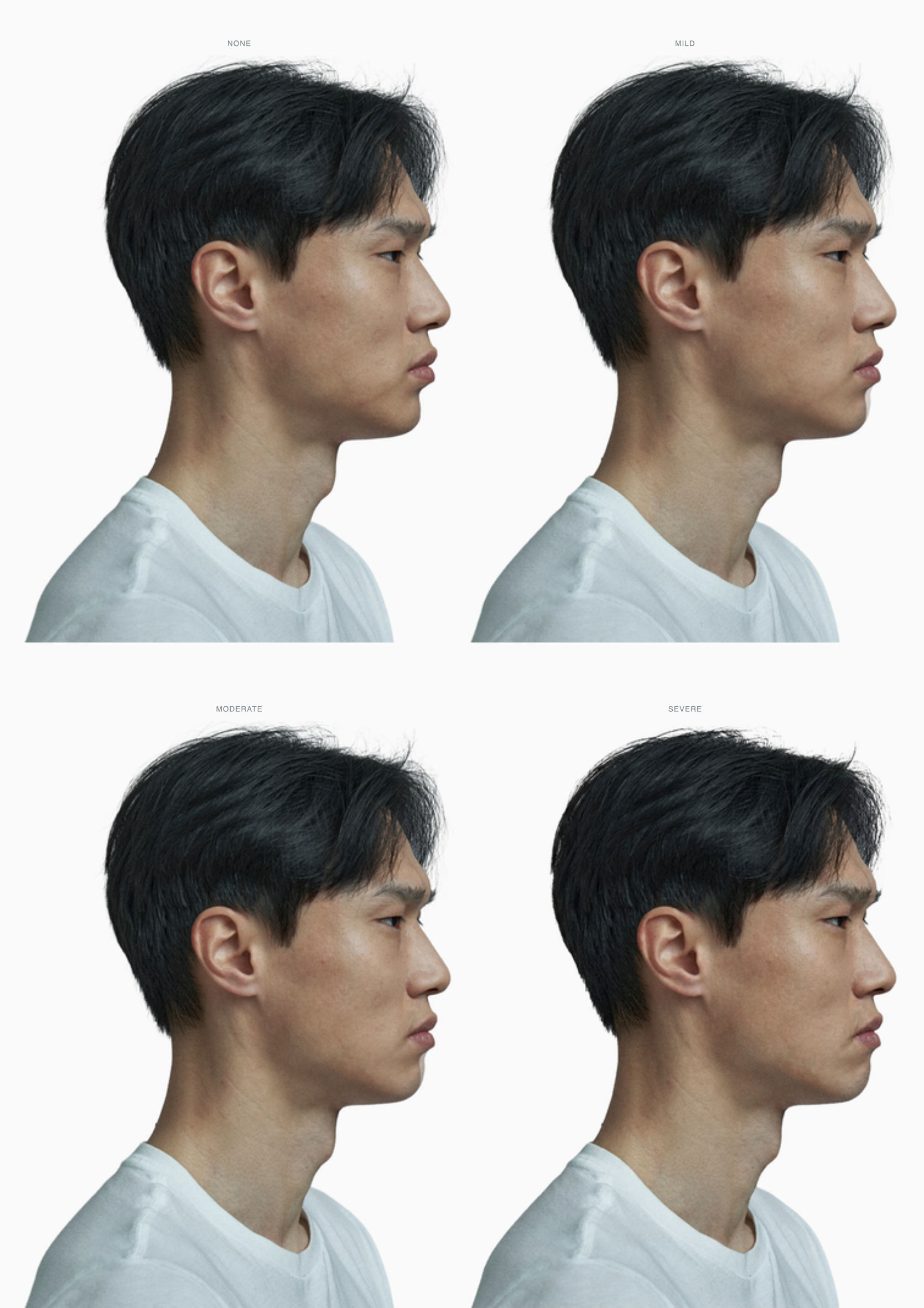 Four-stage severity progression of mandibular retrognathia on a single male profile from none to severe, identity and framing held constant Four-stage severity progression of mandibular retrognathia on a single male profile from none to severe, identity and framing held constant
