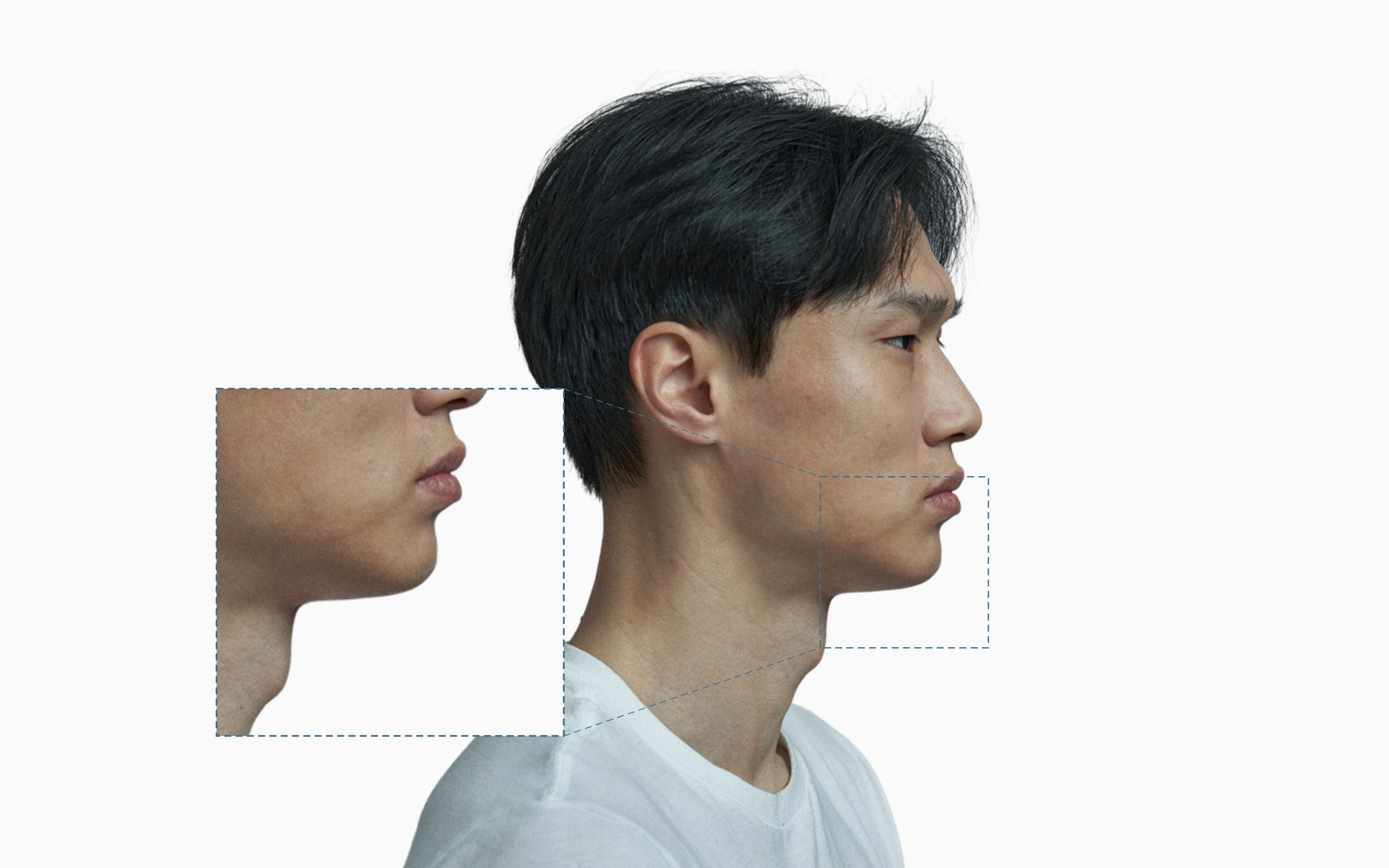 Male profile portrait with a dashed callout on the lower face and an adjacent zoom panel highlighting the recessed chin and mandibular contour Male profile portrait with a dashed callout on the lower face and an adjacent zoom panel highlighting the recessed chin and mandibular contour