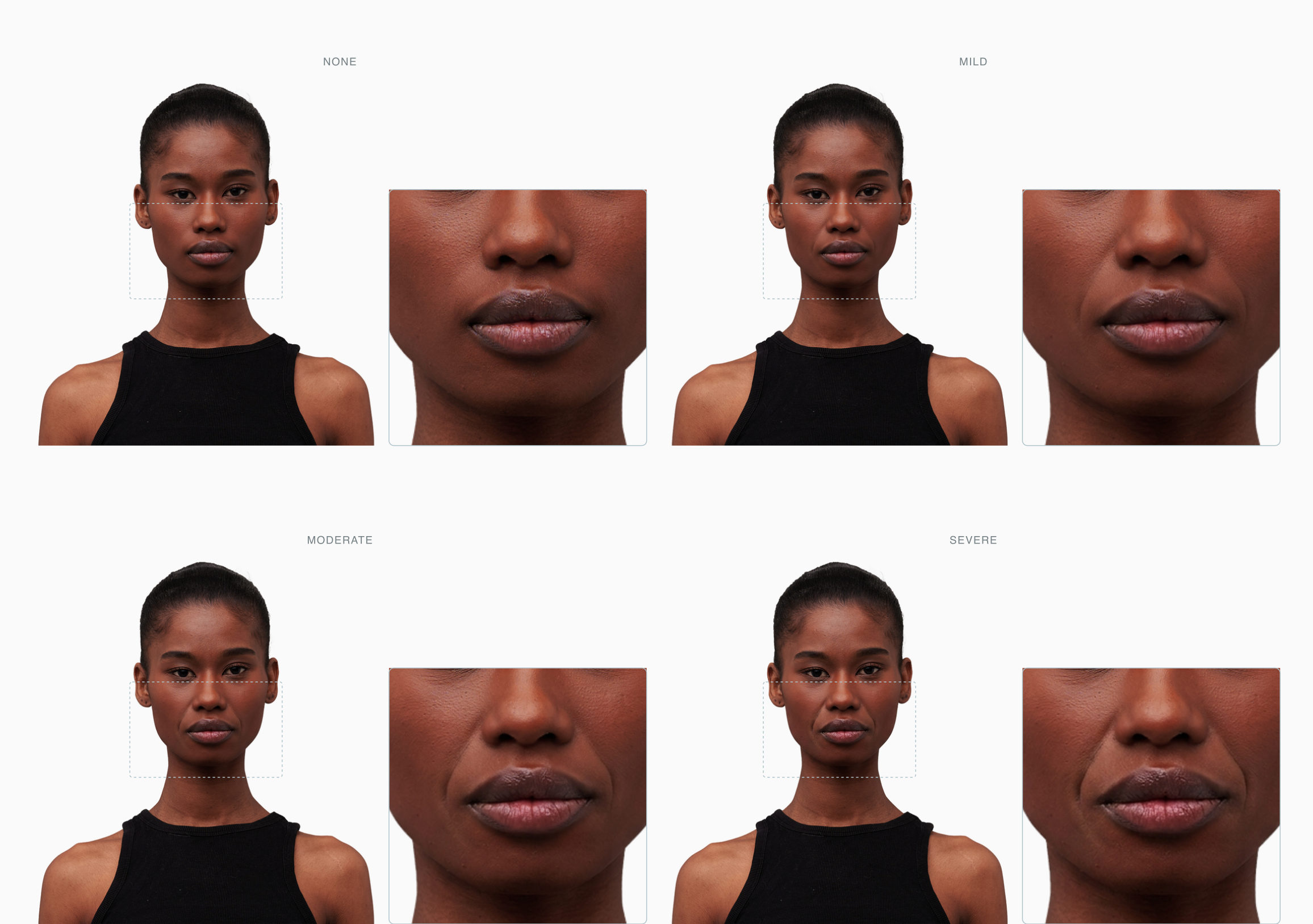 Nasolabial fold severity progression on a single face — none, mild, moderate, severe Nasolabial fold severity progression on a single face — none, mild, moderate, severe