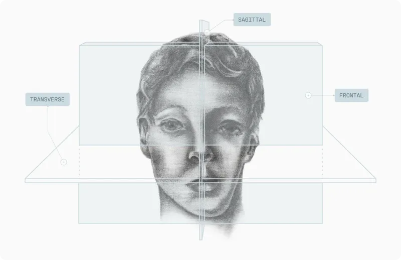 Side-view illustration of hemifacial microsomia with sagittal, frontal and transverse craniofacial planes labelled