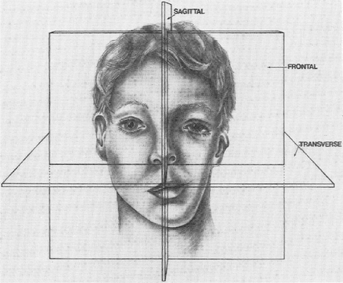 Drawing of hemifacial microsomia
