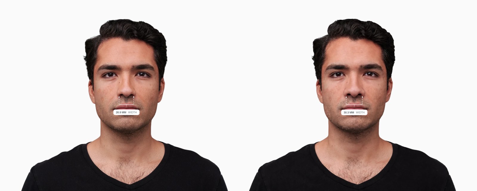 Two copies of the same male front-facing face with the alar width drawn on each, the right one with wider nostrils Two copies of the same male front-facing face with the alar width drawn on each, the right one with wider nostrils