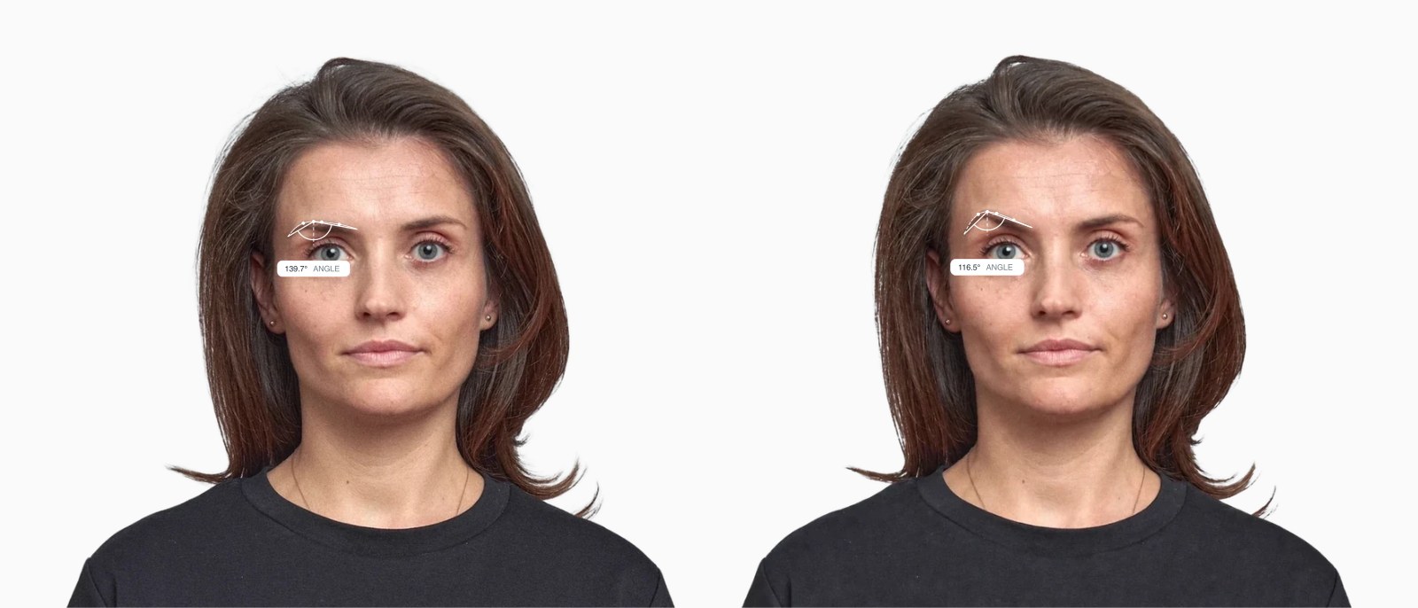 Two copies of the same female front-facing face with the brow apex angle drawn on each, the right one with a more sharply arched brow Two copies of the same female front-facing face with the brow apex angle drawn on each, the right one with a more sharply arched brow