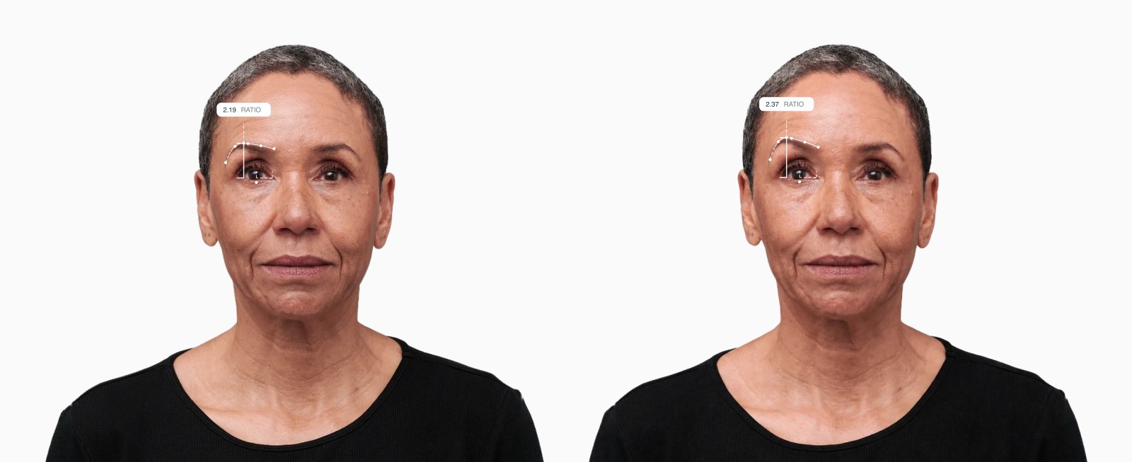 Two copies of the same female front-facing face with the brow elevation drawn on each, the right one with a higher-set brow