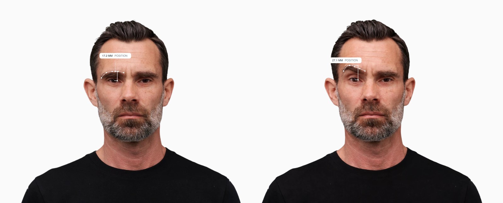 Two copies of the same male front-facing face with the brow position drawn on each, the right one with the brow lifted higher above the eye Two copies of the same male front-facing face with the brow position drawn on each, the right one with the brow lifted higher above the eye