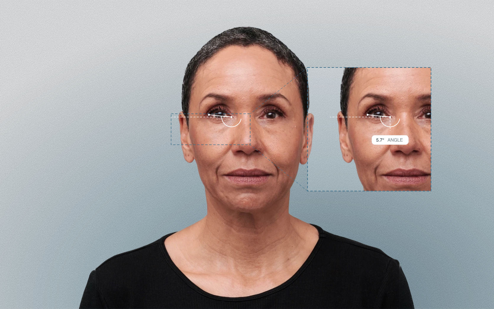 Canthal tilt measured on a female front-facing portrait Canthal tilt measured on a female front-facing portrait