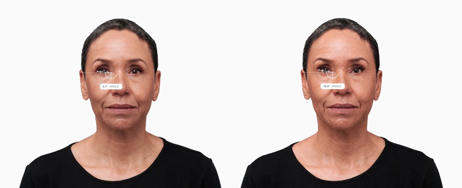 Two copies of the same female front-facing face with the canthal tilt drawn on each, the right one with the outer eye corners lifted Two copies of the same female front-facing face with the canthal tilt drawn on each, the right one with the outer eye corners lifted