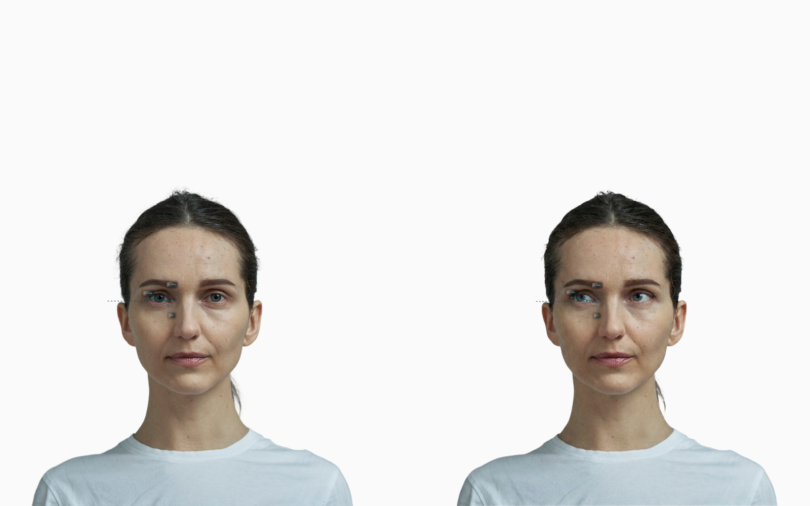 Canthal tilt before-and-after comparison on a female face