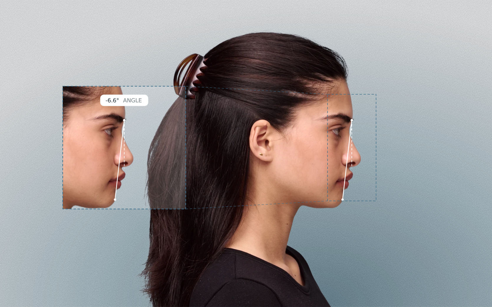 Chin projection measured on a female side-profile portrait Chin projection measured on a female side-profile portrait