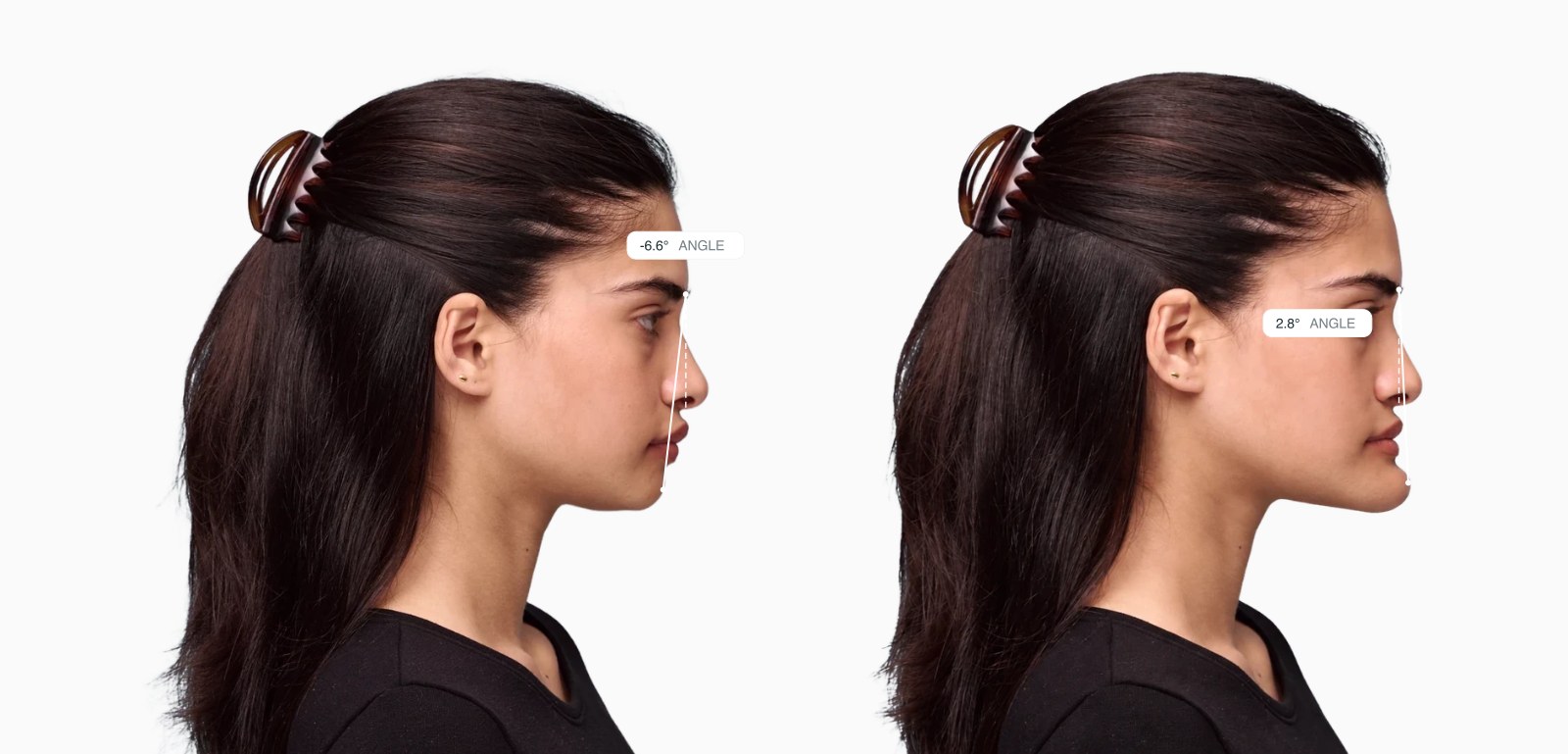 Two copies of the same female side-profile face with the chin projection drawn on each, the right one with the chin pushed forward Two copies of the same female side-profile face with the chin projection drawn on each, the right one with the chin pushed forward