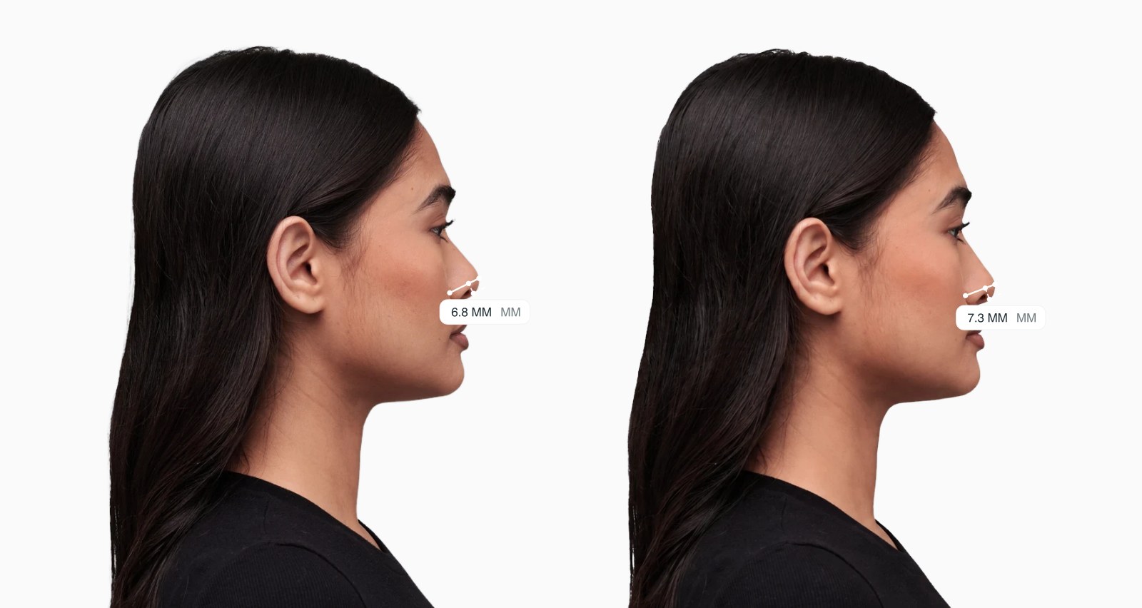 Two copies of the same female side-profile face with the columella show drawn on each, the right one with more of the columella showing below the nostrils Two copies of the same female side-profile face with the columella show drawn on each, the right one with more of the columella showing below the nostrils