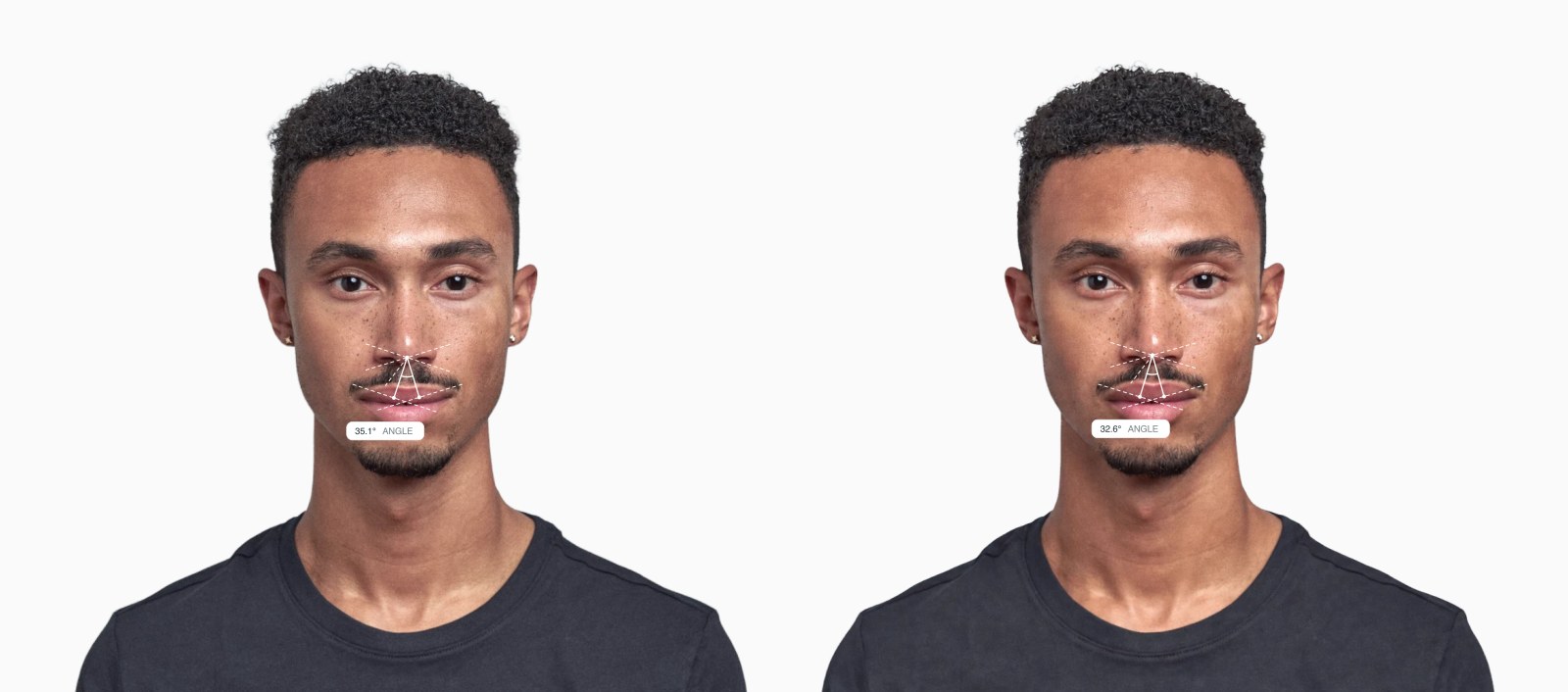 Two copies of the same male front-facing face with the cupid's bow angle drawn on each, the right one with slightly sharper cupid's bow peaks Two copies of the same male front-facing face with the cupid's bow angle drawn on each, the right one with slightly sharper cupid's bow peaks
