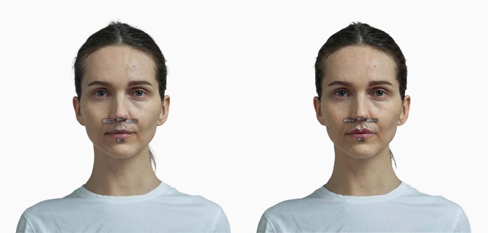 Cupids bow before-and-after comparison on a female face