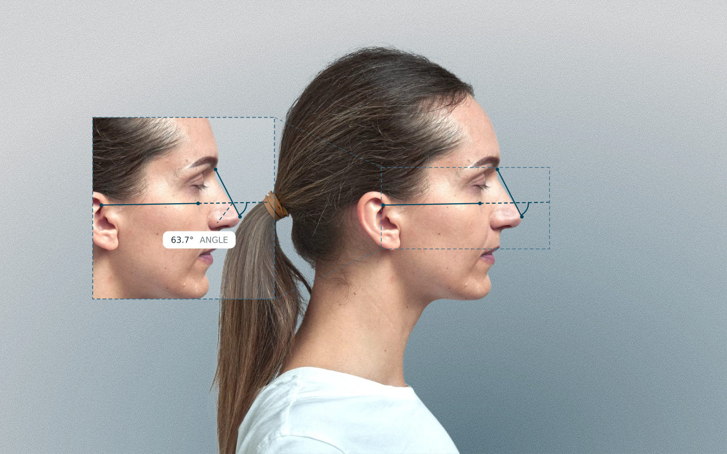 Dorsal axis angle measured on a female side-profile portrait Dorsal axis angle measured on a female side-profile portrait