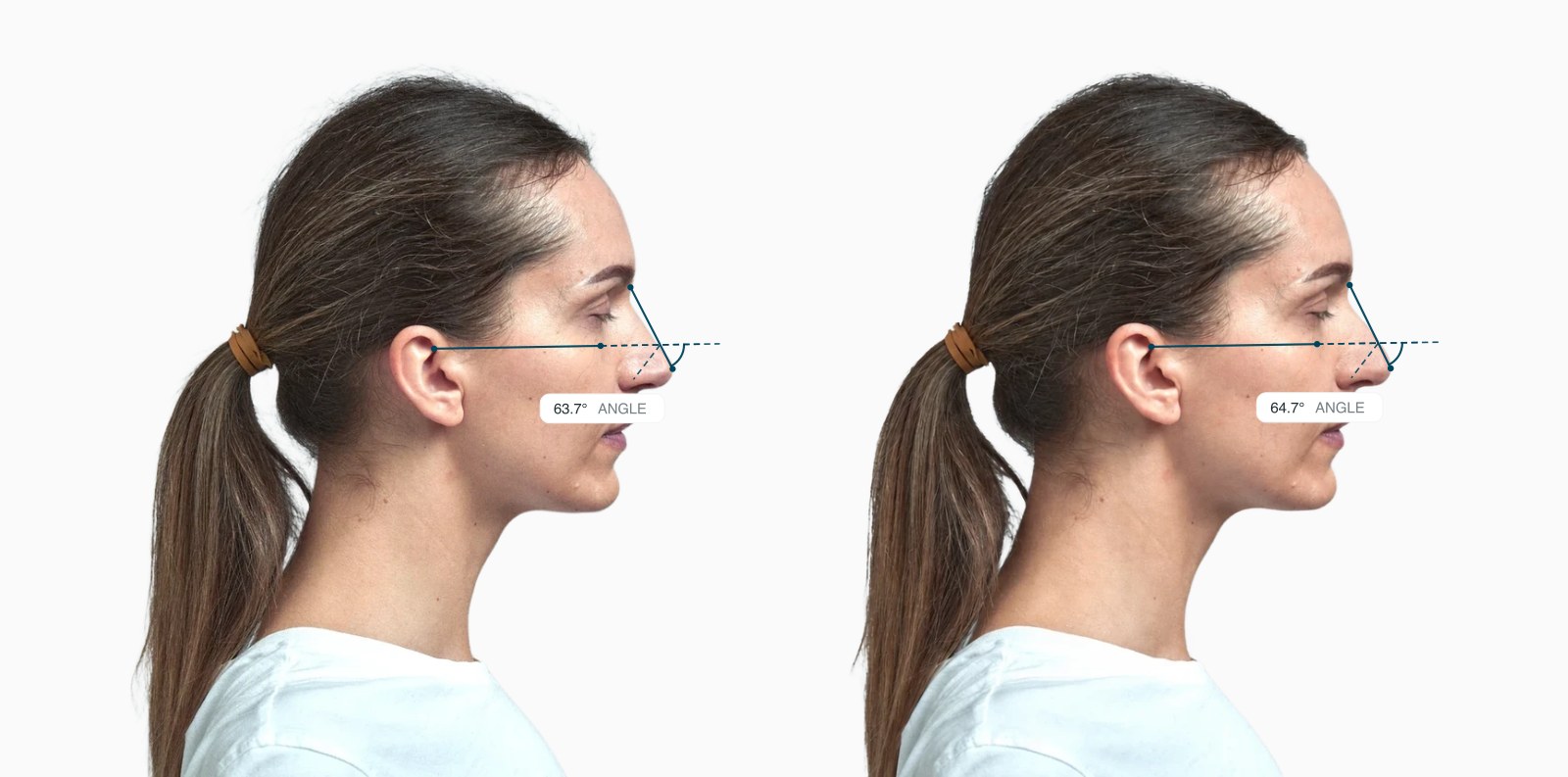 Two copies of the same female side-profile face with the dorsal axis angle drawn on each, the right one with a slightly reshaped nose Two copies of the same female side-profile face with the dorsal axis angle drawn on each, the right one with a slightly reshaped nose