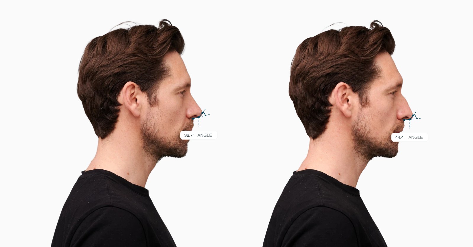 Two copies of the same male side-profile face with the double break angle drawn on each, the right one with a reshaped nasal tip Two copies of the same male side-profile face with the double break angle drawn on each, the right one with a reshaped nasal tip