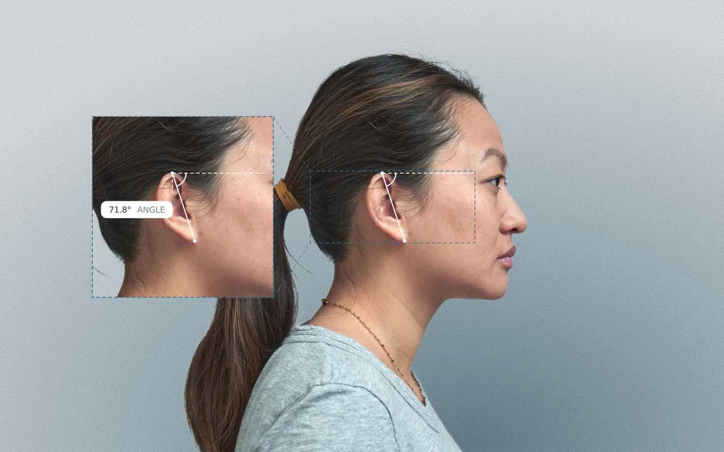 Ear axis angle measured on a female side-profile portrait Ear axis angle measured on a female side-profile portrait