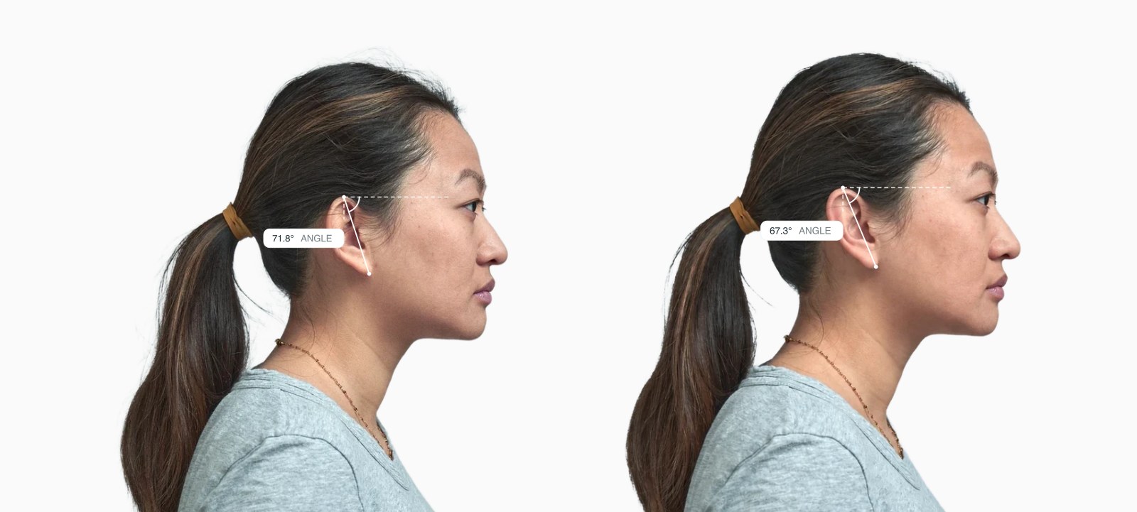 Two copies of the same female side-profile face with the ear axis angle drawn on each, the right one with the ear set at a different angle Two copies of the same female side-profile face with the ear axis angle drawn on each, the right one with the ear set at a different angle