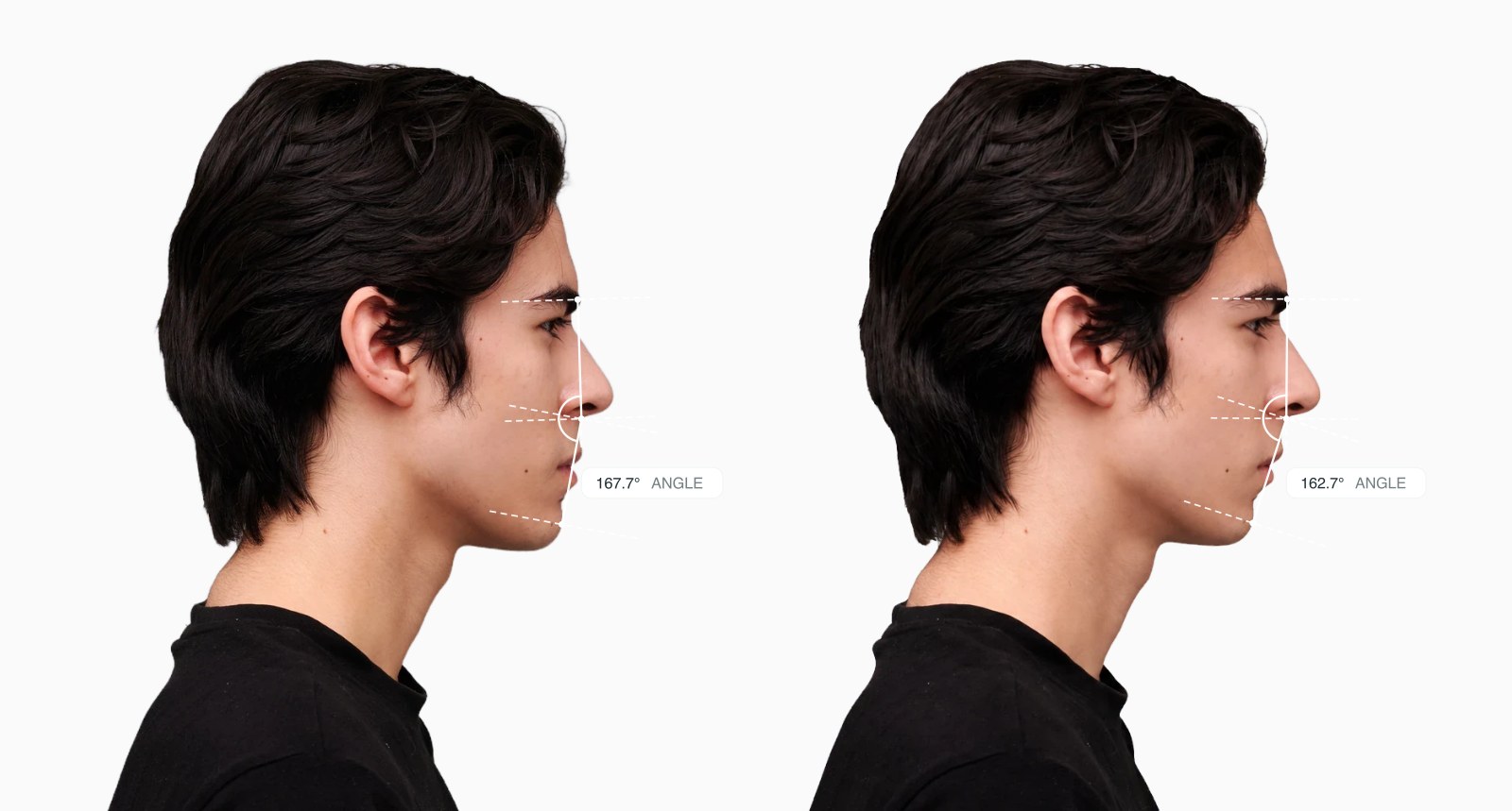 Two copies of the same male side-profile face with the facial convexity angle drawn on each, the right one with a more convex profile Two copies of the same male side-profile face with the facial convexity angle drawn on each, the right one with a more convex profile