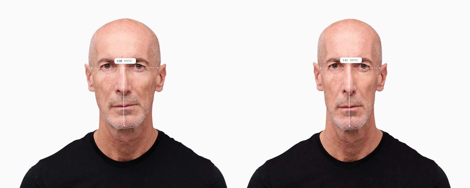 Two copies of the same male front-facing face with the facial index drawn on each, the right one with a longer, narrower face Two copies of the same male front-facing face with the facial index drawn on each, the right one with a longer, narrower face