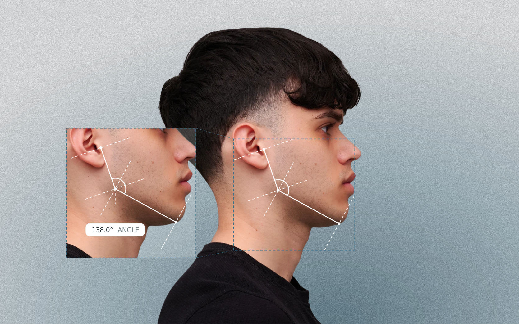 Gonial angle measured on a male side-profile portrait Gonial angle measured on a male side-profile portrait