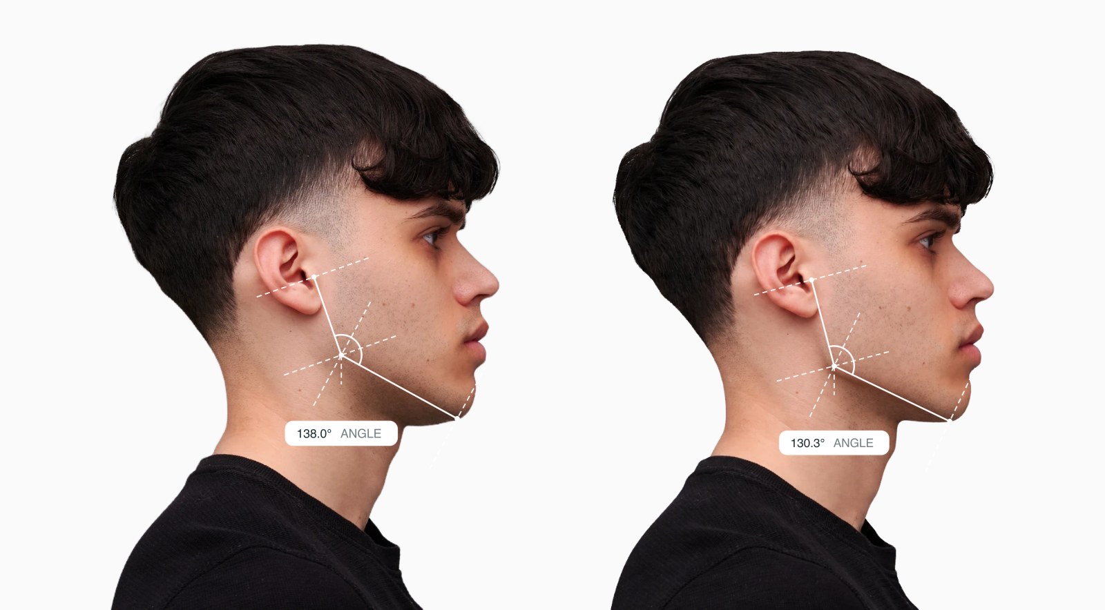 Two copies of the same male side-profile face with the gonial angle drawn on each, the right one with a sharper jaw angle Two copies of the same male side-profile face with the gonial angle drawn on each, the right one with a sharper jaw angle