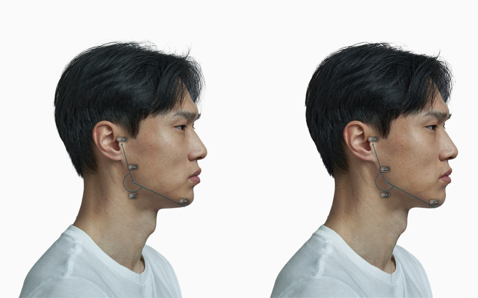 Gonial angle before and after comparison on a male side profile, showing the original sharper mandibular corner alongside a softened wider corner with the angle annotation drawn on each