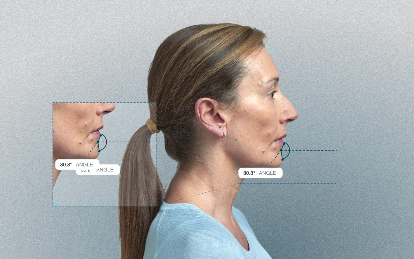 Labiomental angle measured on a female side-profile portrait Labiomental angle measured on a female side-profile portrait