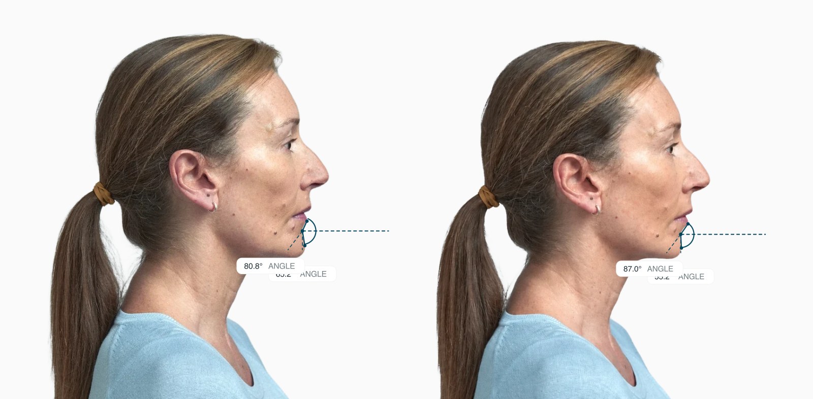 Two copies of the same female side-profile face with the labiomental angles drawn on each, the right one with a deeper fold between the lower lip and chin Two copies of the same female side-profile face with the labiomental angles drawn on each, the right one with a deeper fold between the lower lip and chin