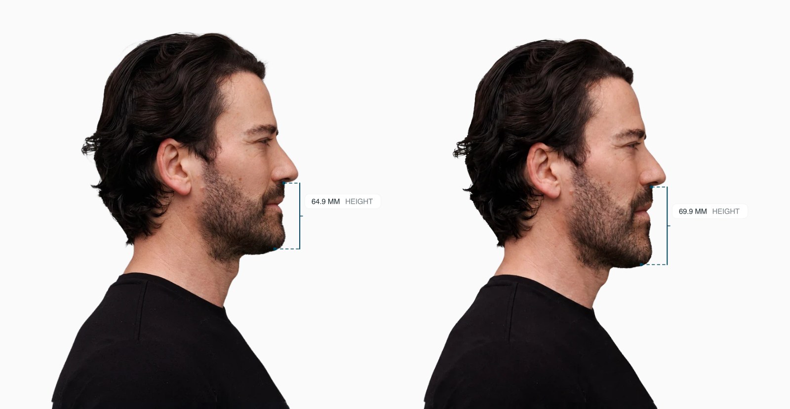 Two copies of the same male side-profile face with the lower anterior face height drawn on each, the right one with a taller lower face Two copies of the same male side-profile face with the lower anterior face height drawn on each, the right one with a taller lower face